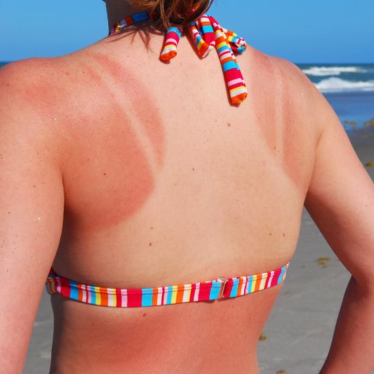 How To Safely Treat Sunburn